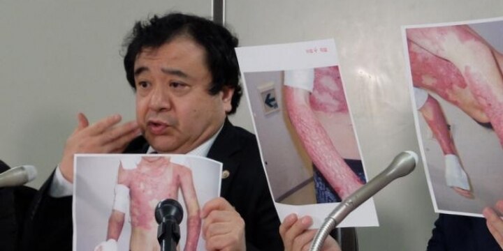 「同僚にガソリンかけられ大やけど」元技能実習生の中国人が提訴、深刻な後遺症